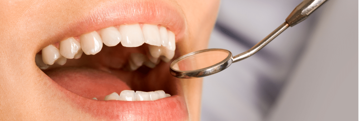 The Pros & Cons Of Teeth Whitening