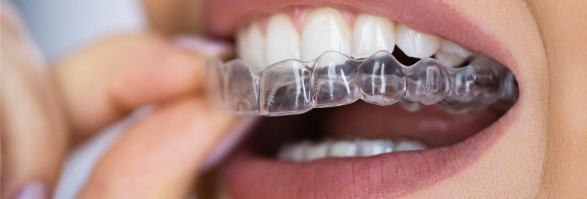 How To Prolong The Lifespan Of Your Retainers