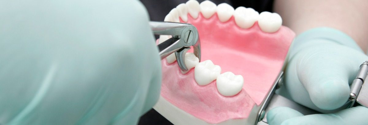 Why You Should Replace Missing Teeth