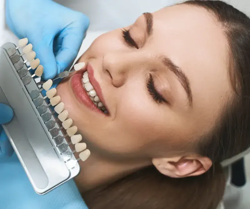 veneers