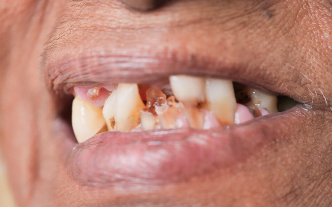 Protecting Your Smile: Identifying Habits Harmful to Your Teeth