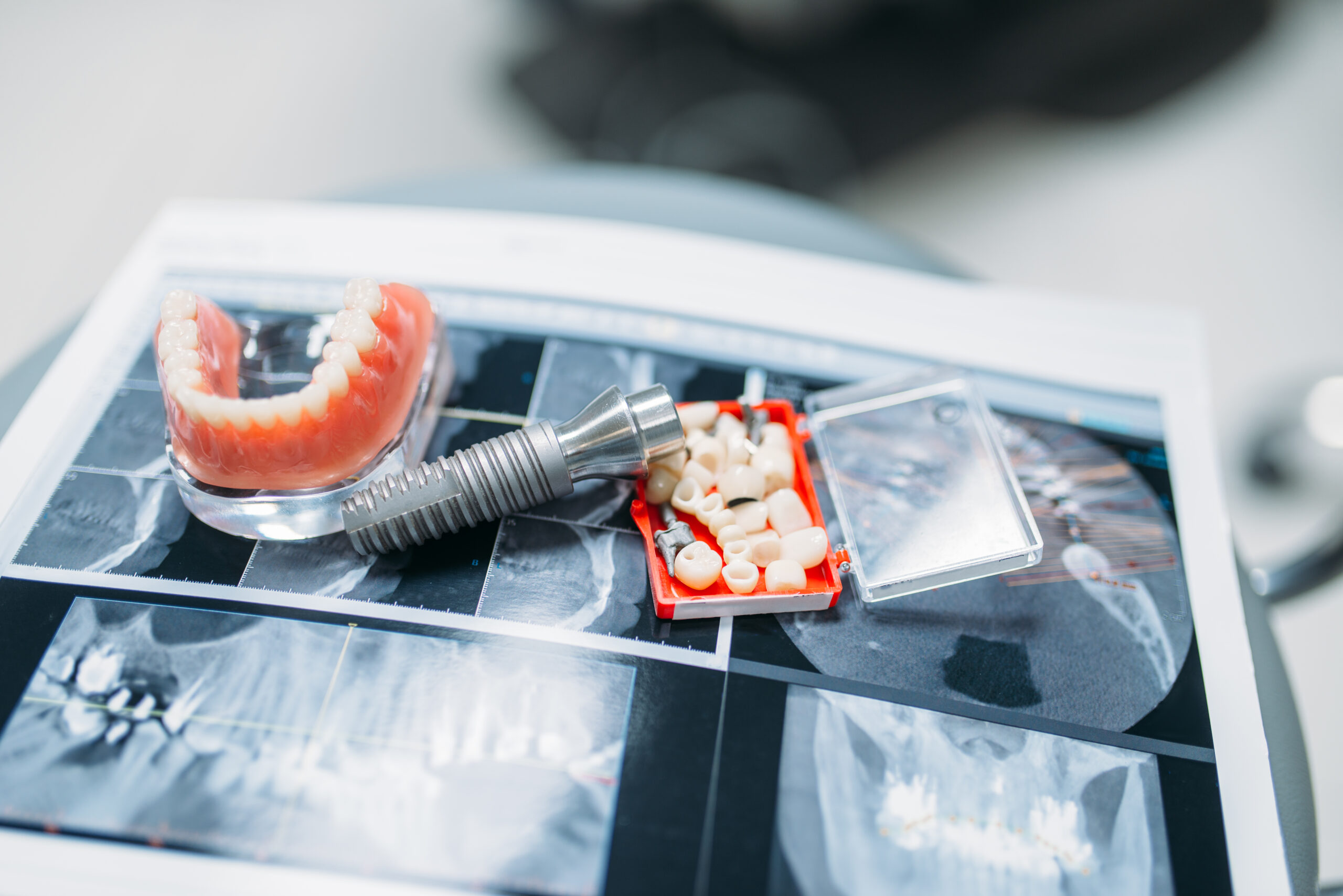 Dental Implants