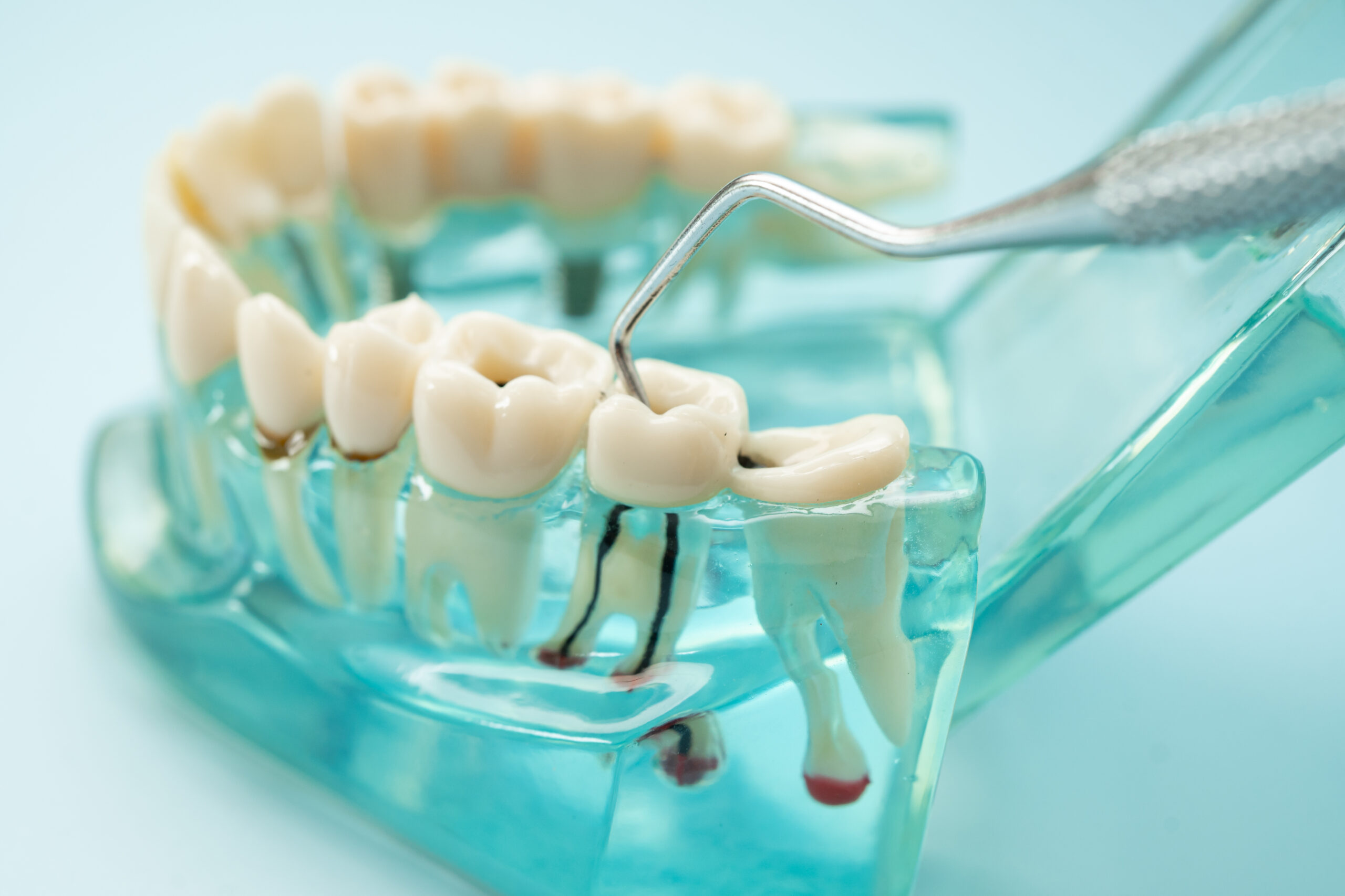 Root Canal