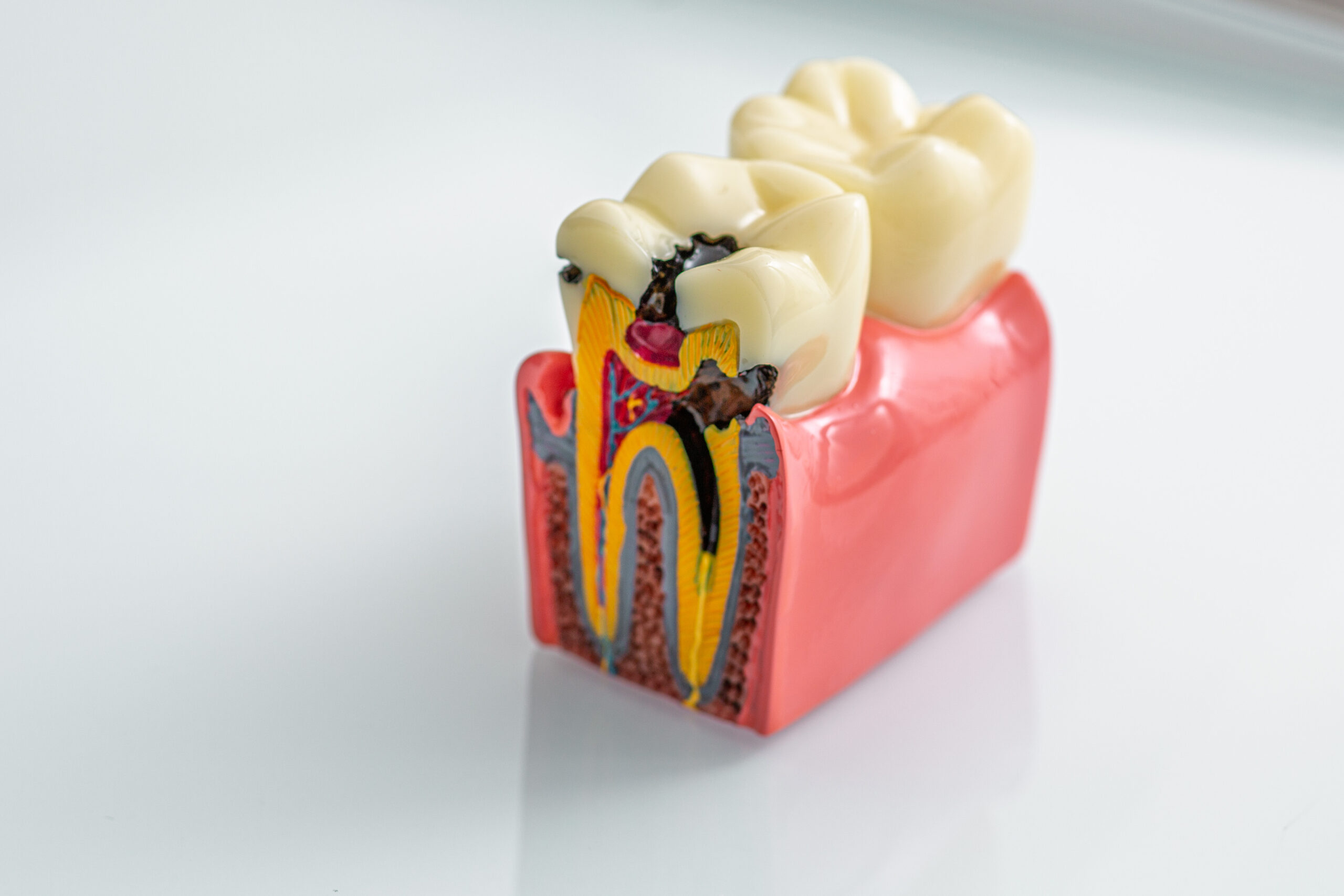 Tooth Decay