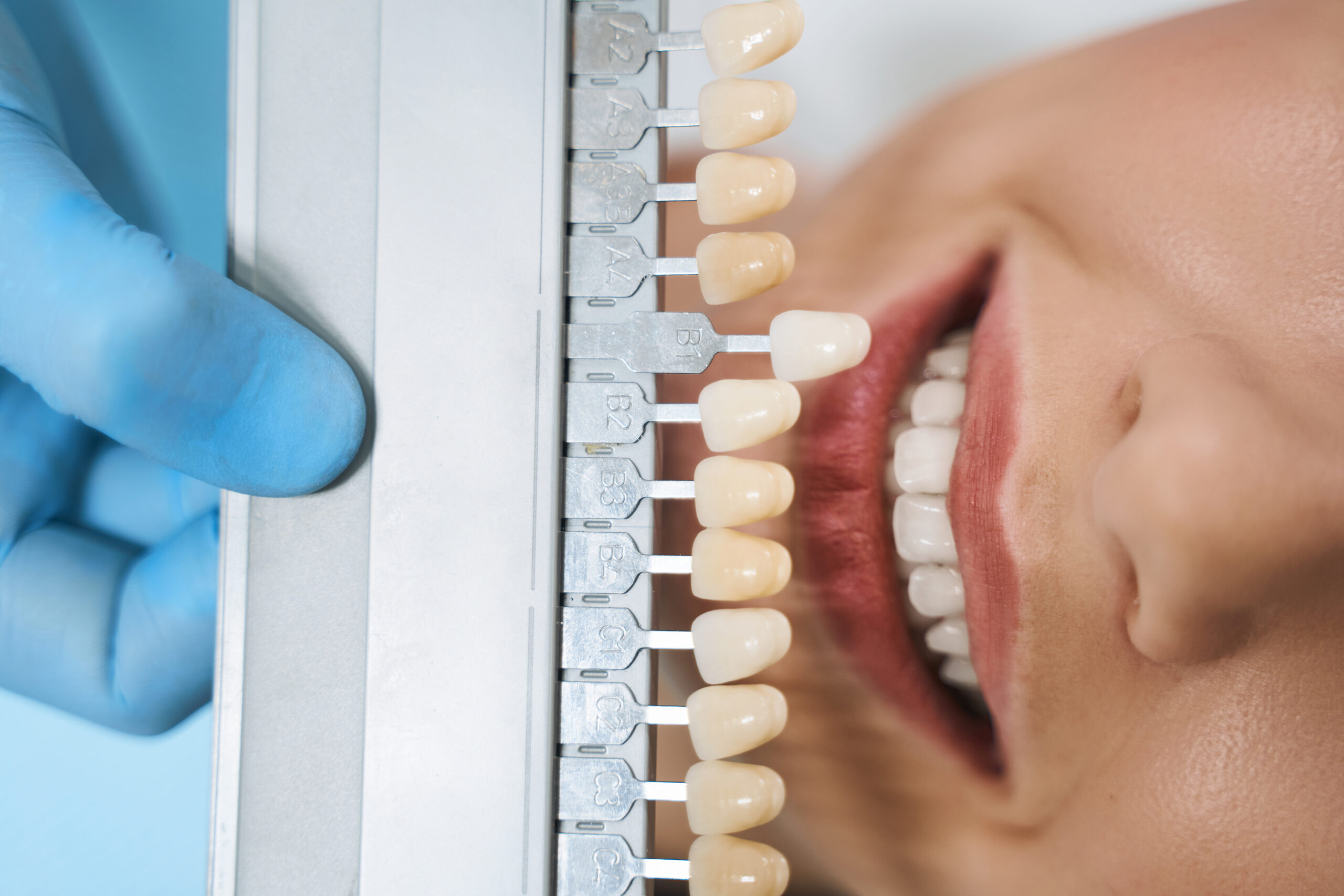 Dental Crowns