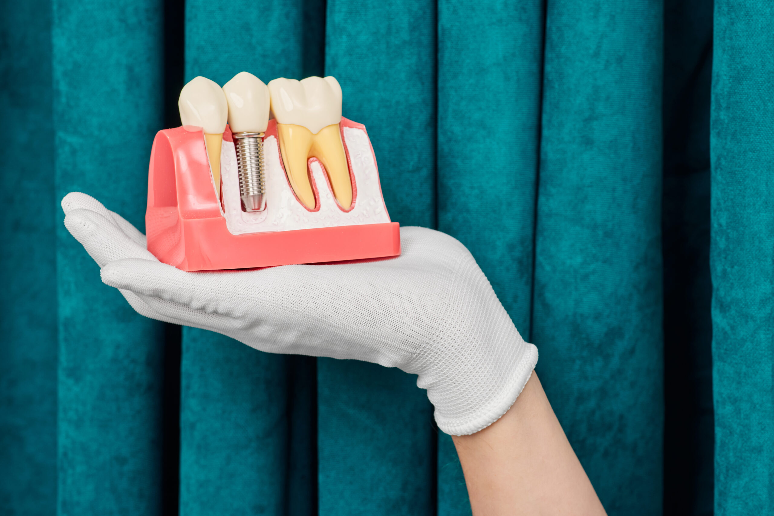 Dental Implants